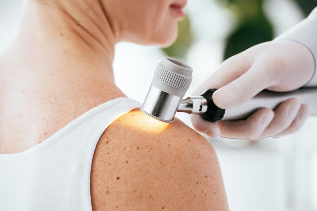 Cancerul de piele: ce aluniţe trebuie să ne dea de gândit?