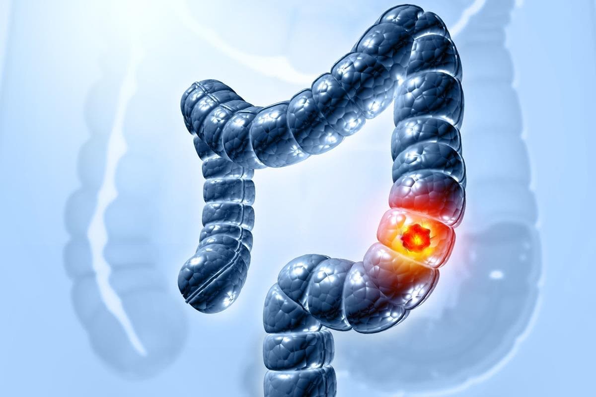 Cancerul colorectal