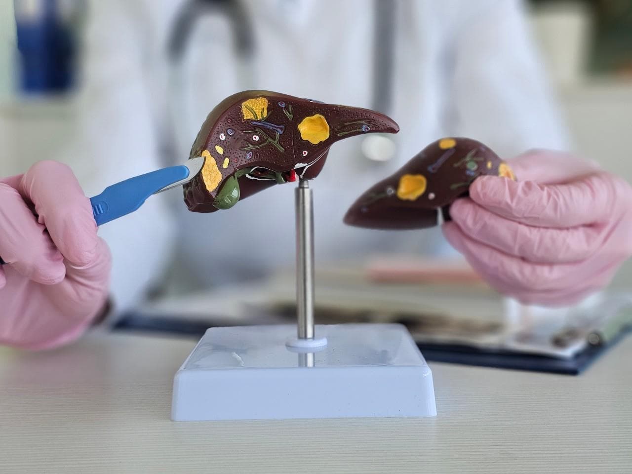 Chist hepatic (chist la ficat): Cauze, simptome și opțiuni de tratament
