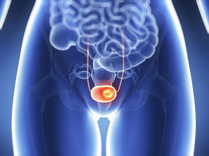 Cistectomie radicală: tratamentul pentru cancerul vezical invaziv și pentru forme recurente de carcinom urotelial