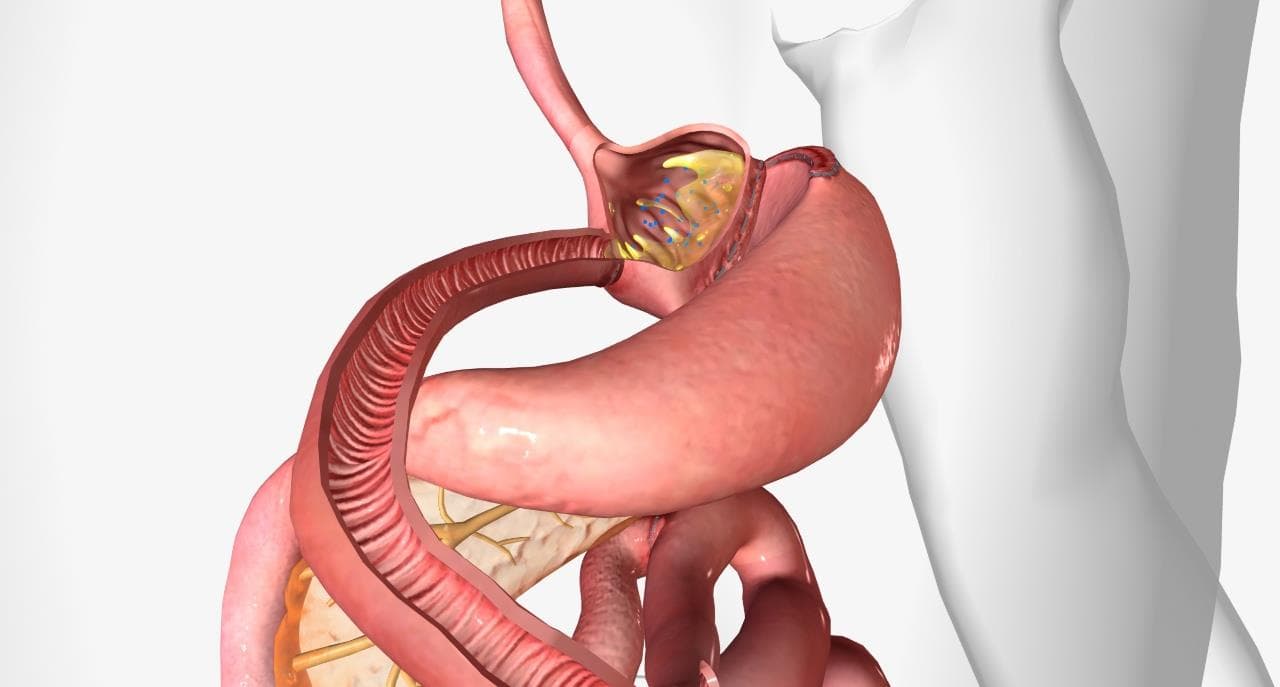 Bypass Gastric