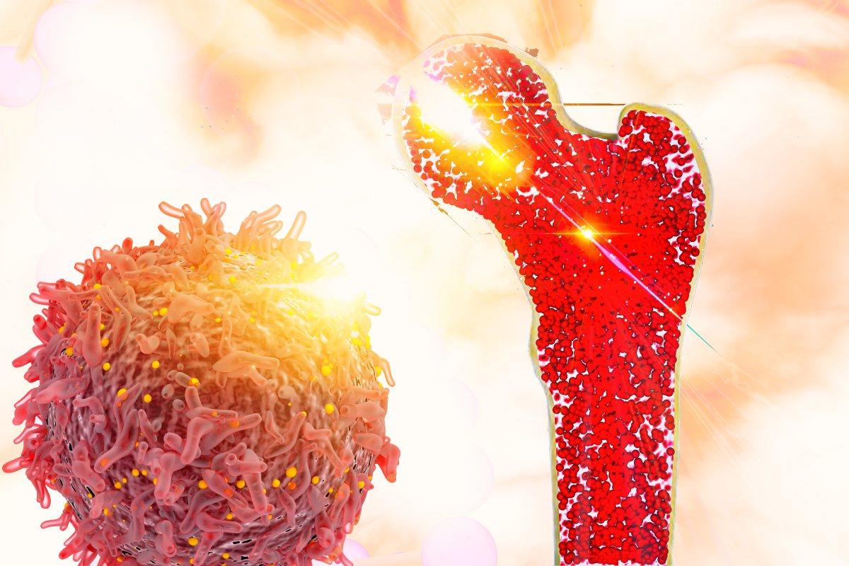Cancerul osos: simptome, diagnostic si tratament
