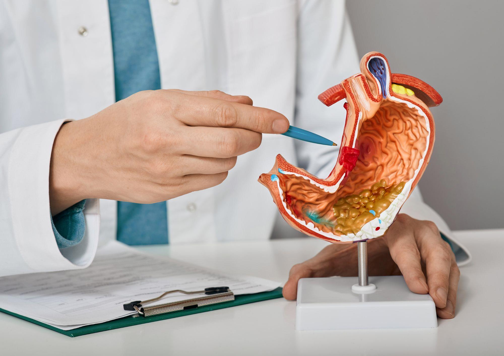 Ulcerul gastroduodenal: cauze, simptome, tratament