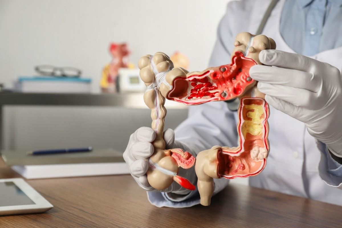 Cum putem preveni cancerul colo-rectal prin colonoscopie?