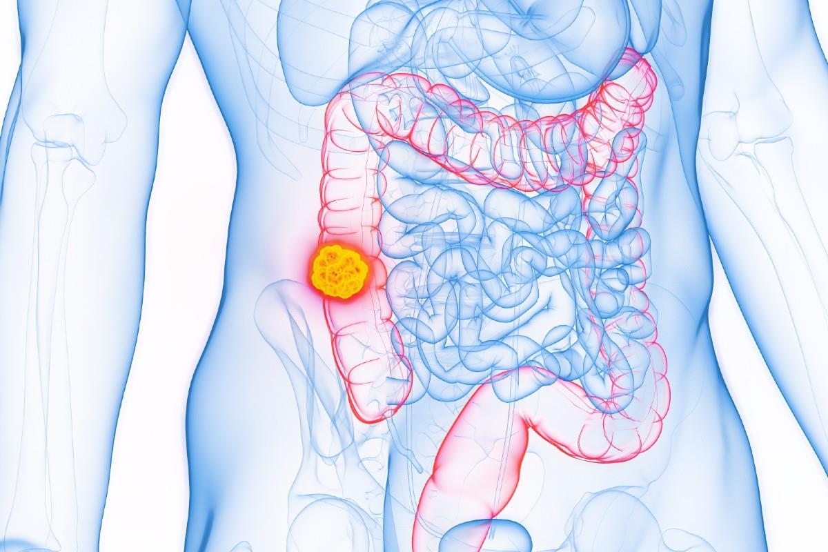 Cancer de colon: cauze, simptome, diagnostic, tratament, prevenție