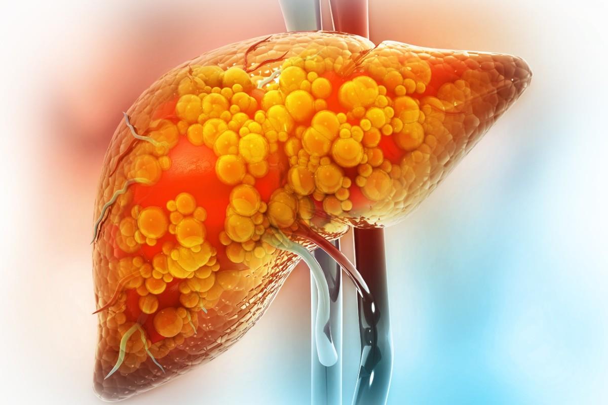 Ciroza hepatică: simptome, diagnostic, tratament 