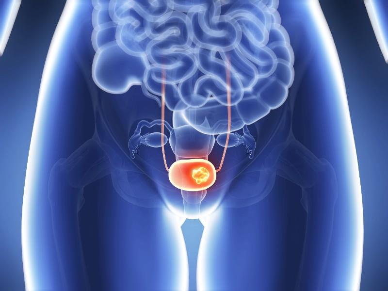 Cistectomie radicală: tratamentul pentru cancerul vezical invaziv și pentru forme recurente de carcinom urotelial
