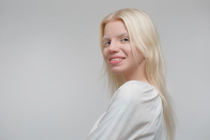 Albinism: cauze, simptome și opțiuni de tratament