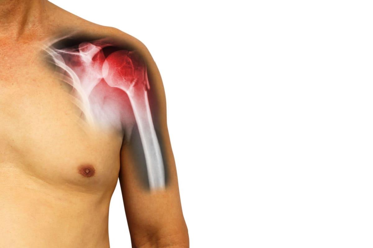 Fractura de humerus: tipuri, cauze, simptome și opțiuni de tratament