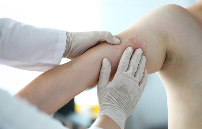 Miliaria (bubițe de la căldură): cauze, simptome, diagnosticare și tratament