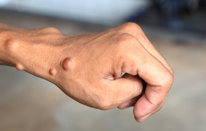 Neurofibromatoza: cauze, simptome, diagnosticare și tratament