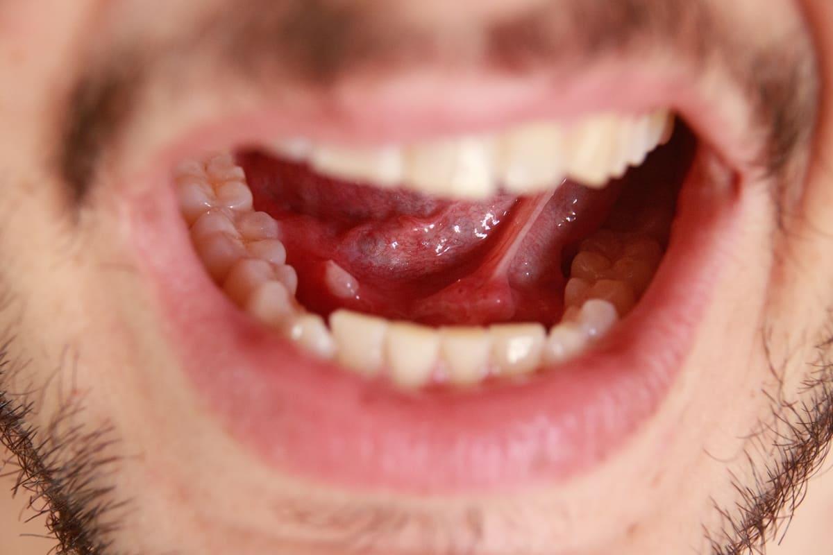 Sialolitiaza (calculi salivari): cauze, simptome, diagnosticare și tratament