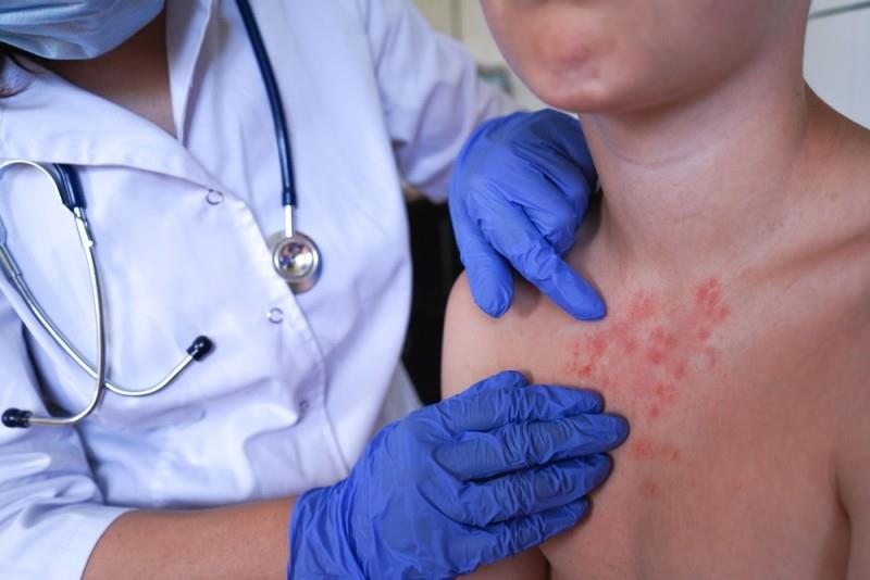 Pecingine: cauze, simptome, diagnosticare și metode de tratament