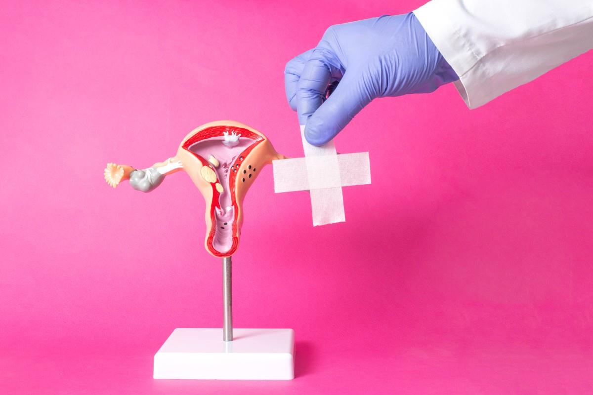 Polipii uterini (endometriali): cauze, simptome și opțiuni de tratament