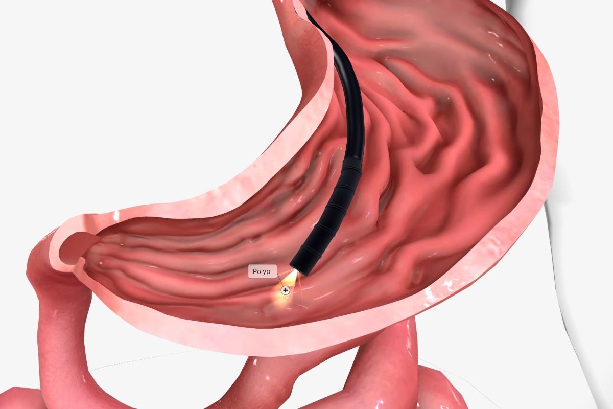 Polipi la stomac (gastrici): tipuri, simptome, tratament