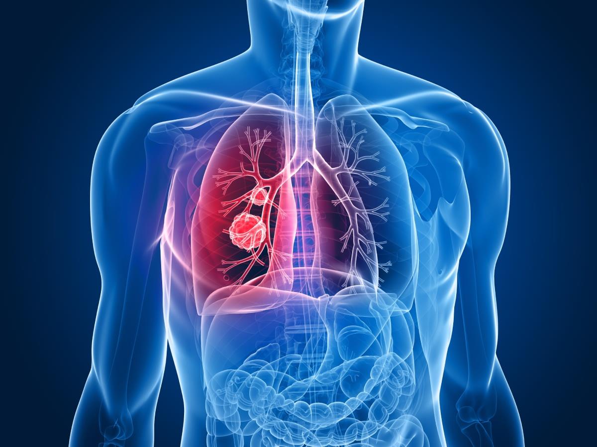 Cancerul la plămâni (bronho-pulmonar): Tratament chirurgical & Șansele de vindecare