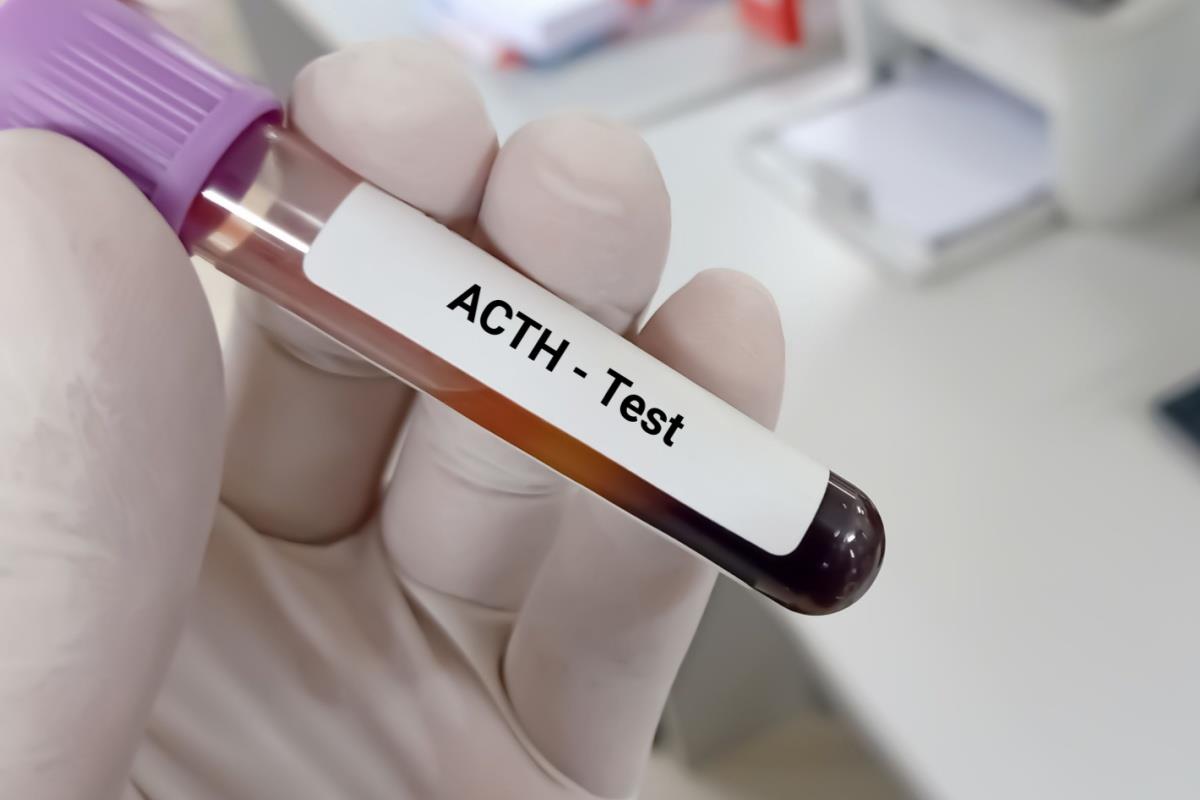 Boala Addison: simptome, cauze, diagnostic și tratament