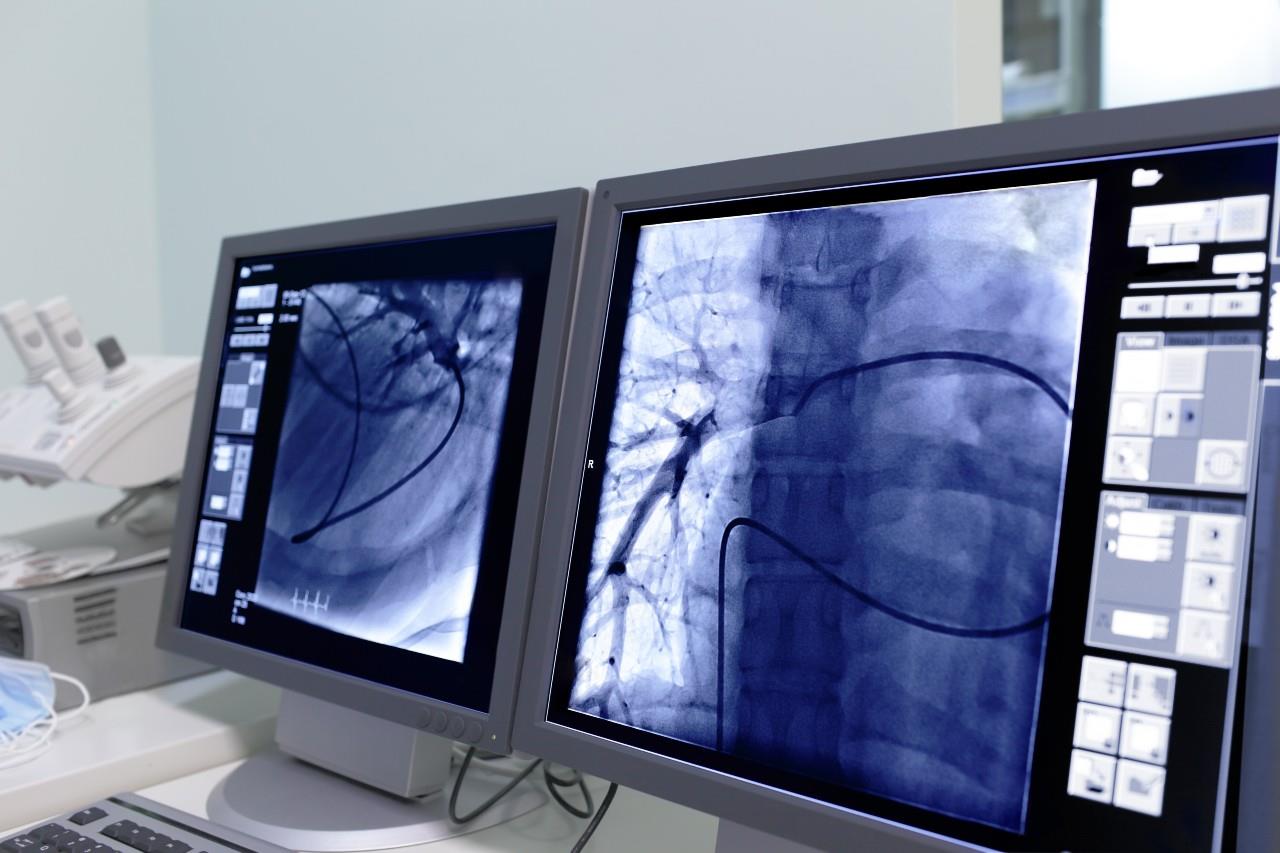 Angiografie