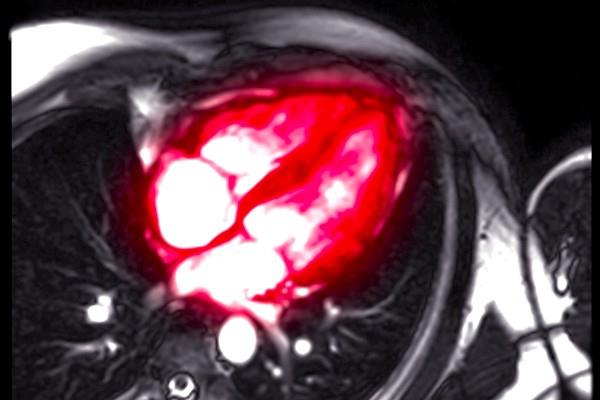 RMN Cardiac sau CardioRM
