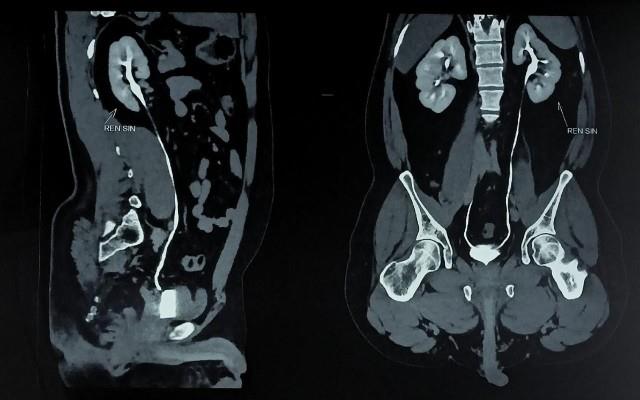 Uro CT sau Urografia CT