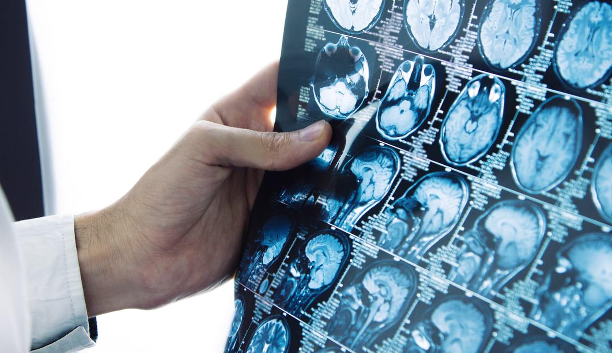 Tehnologii moderne folosite în neuroradiologia intervențională la Memorial România