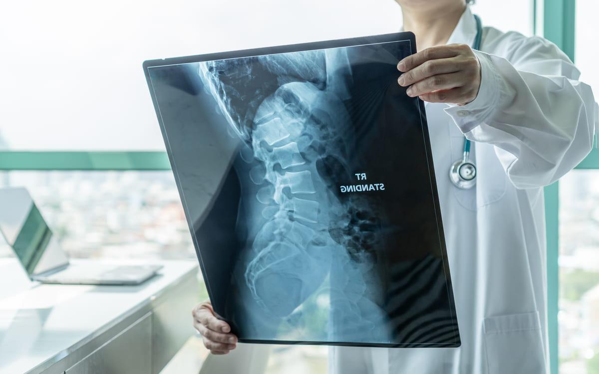 Spondilita anchilozantă: cauze, simptome, diagnostic și tratament